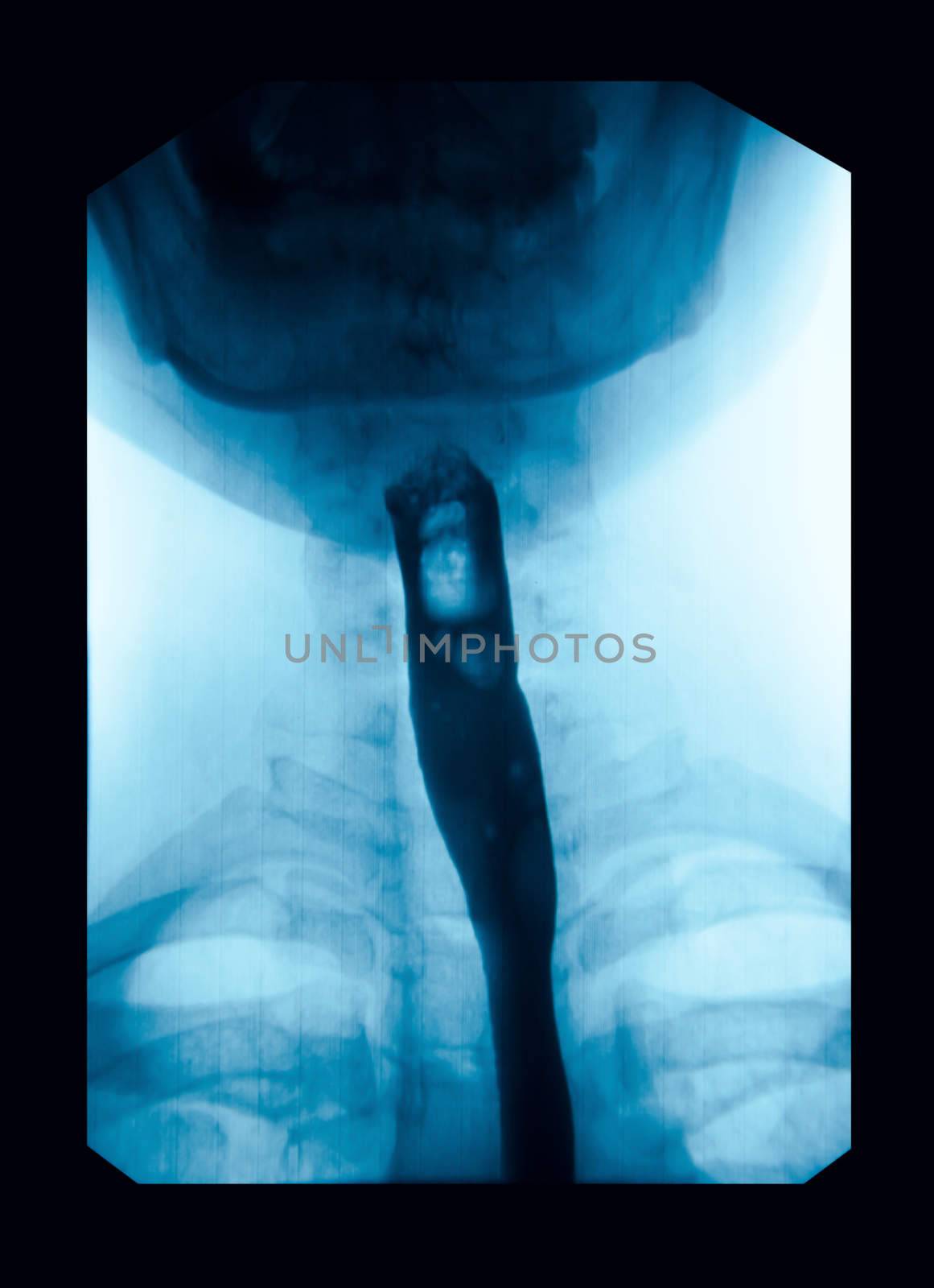 The image of x-ray upper gastrointestinal (UGI), Esophagram use swallow Barium Sulfate method
