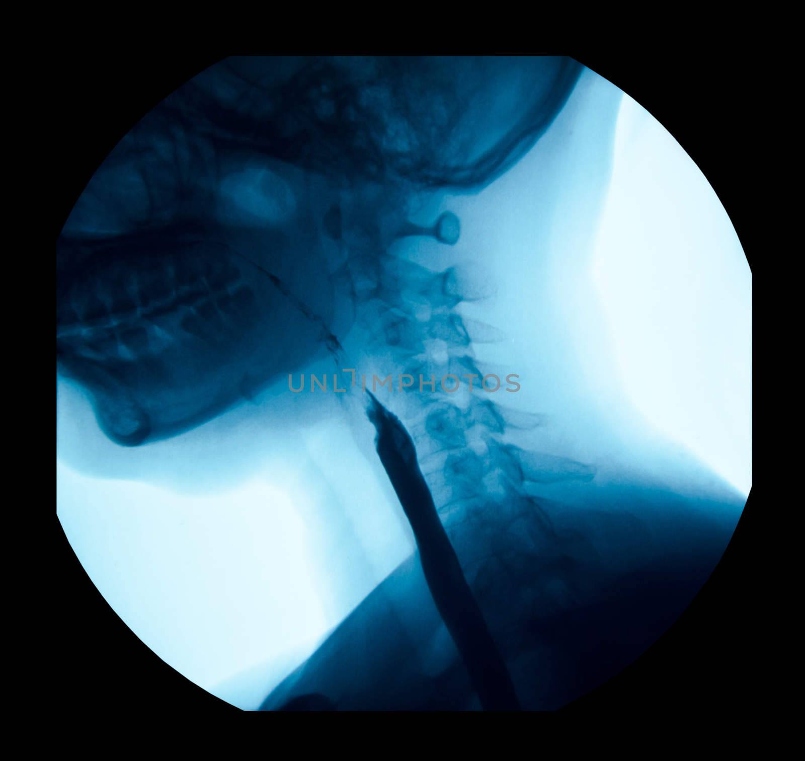 The image of x-ray upper gastrointestinal UGI, Esophagram use swallow Barium Sulfate method