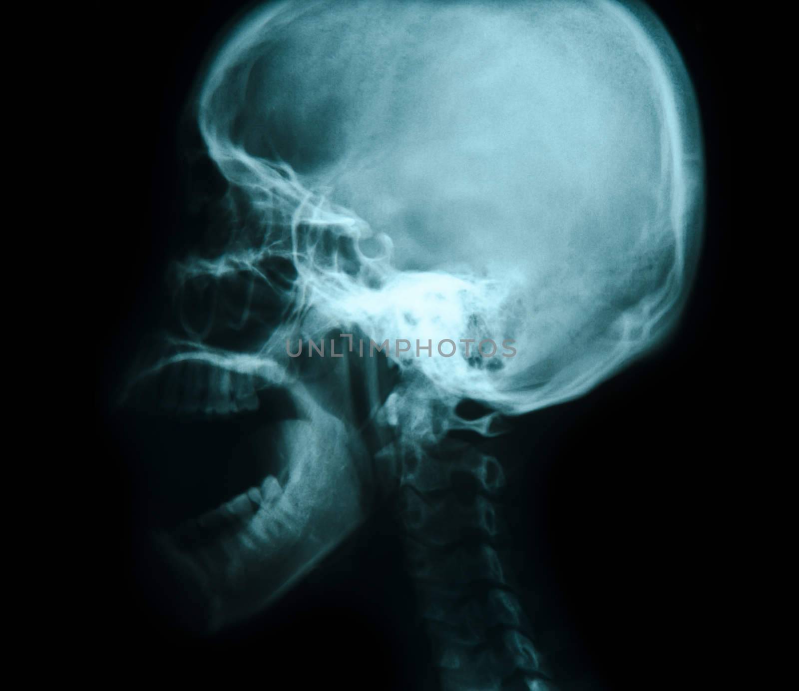 X-ray picture of the skull. Mouth open.