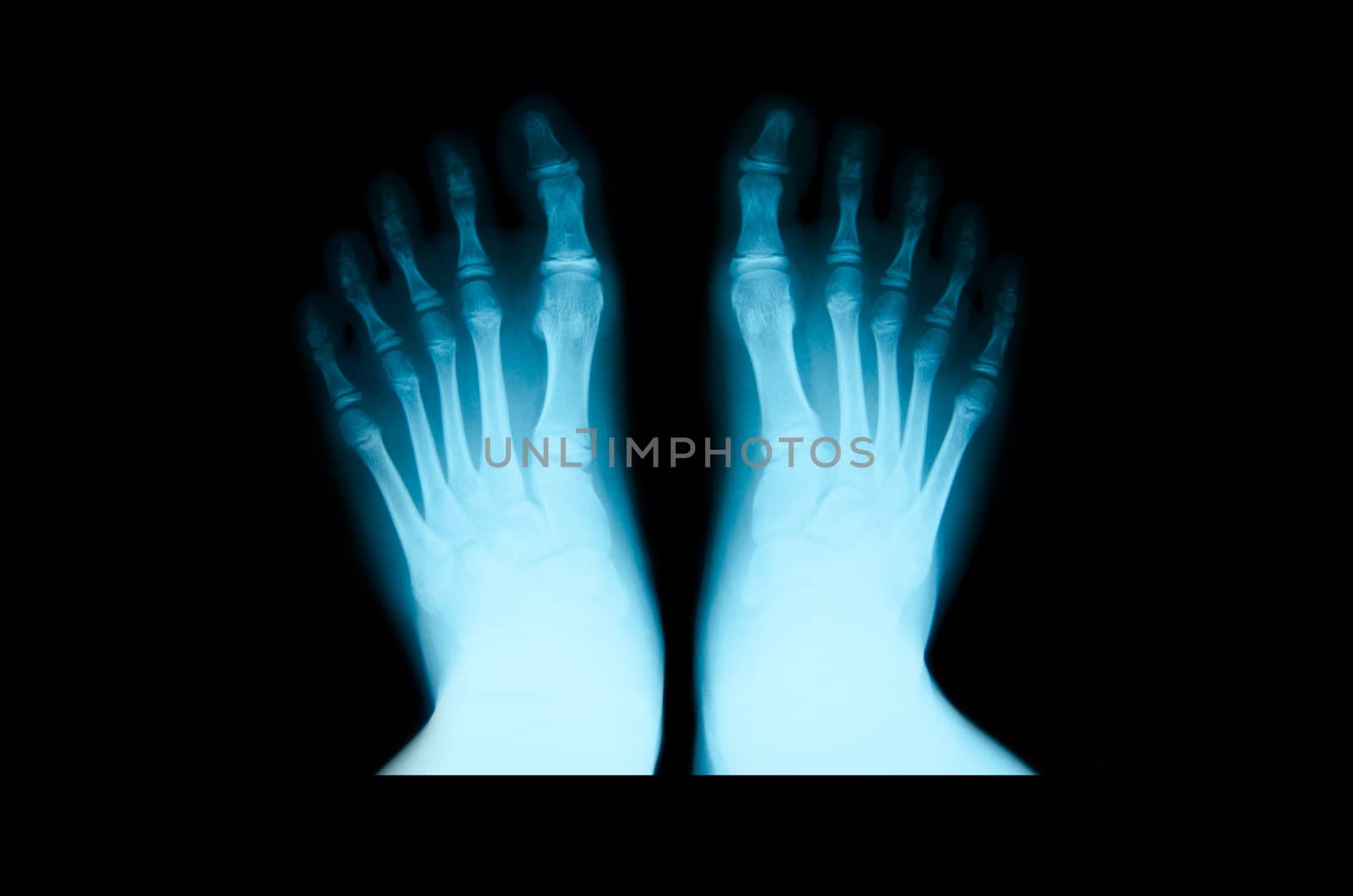 x-ray of foot on black background