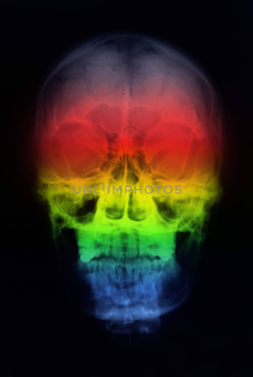 X-ray picture of the skull by Gamjai