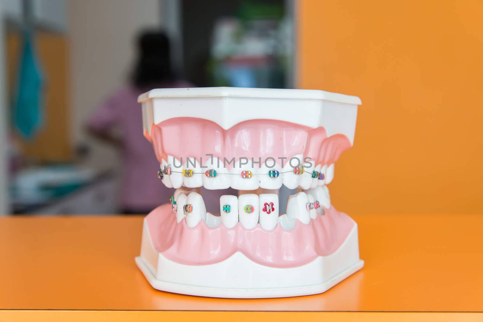 Examples braces by Soranop01