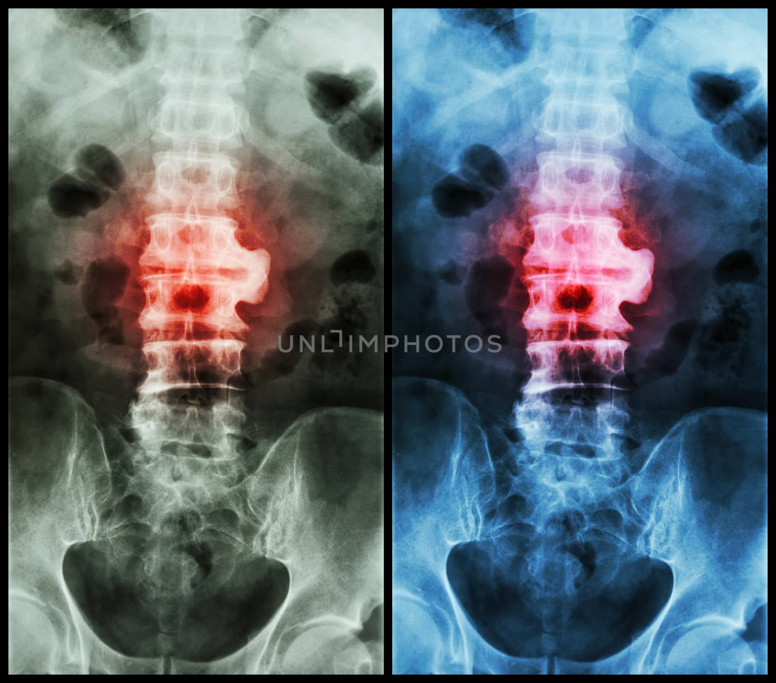 Spondylosis ( film x-ray lumbo - sacral spine : show spondylosis at L2-3 )