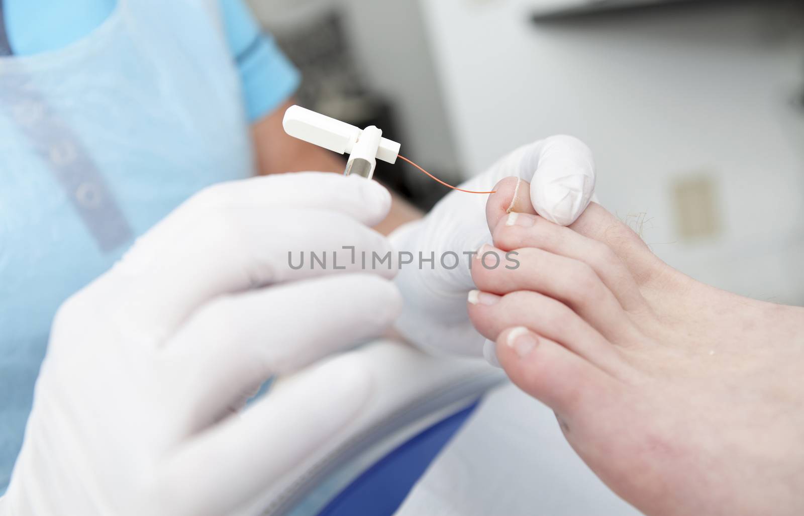 Rheumatism feet treatment by pedicure in closeup