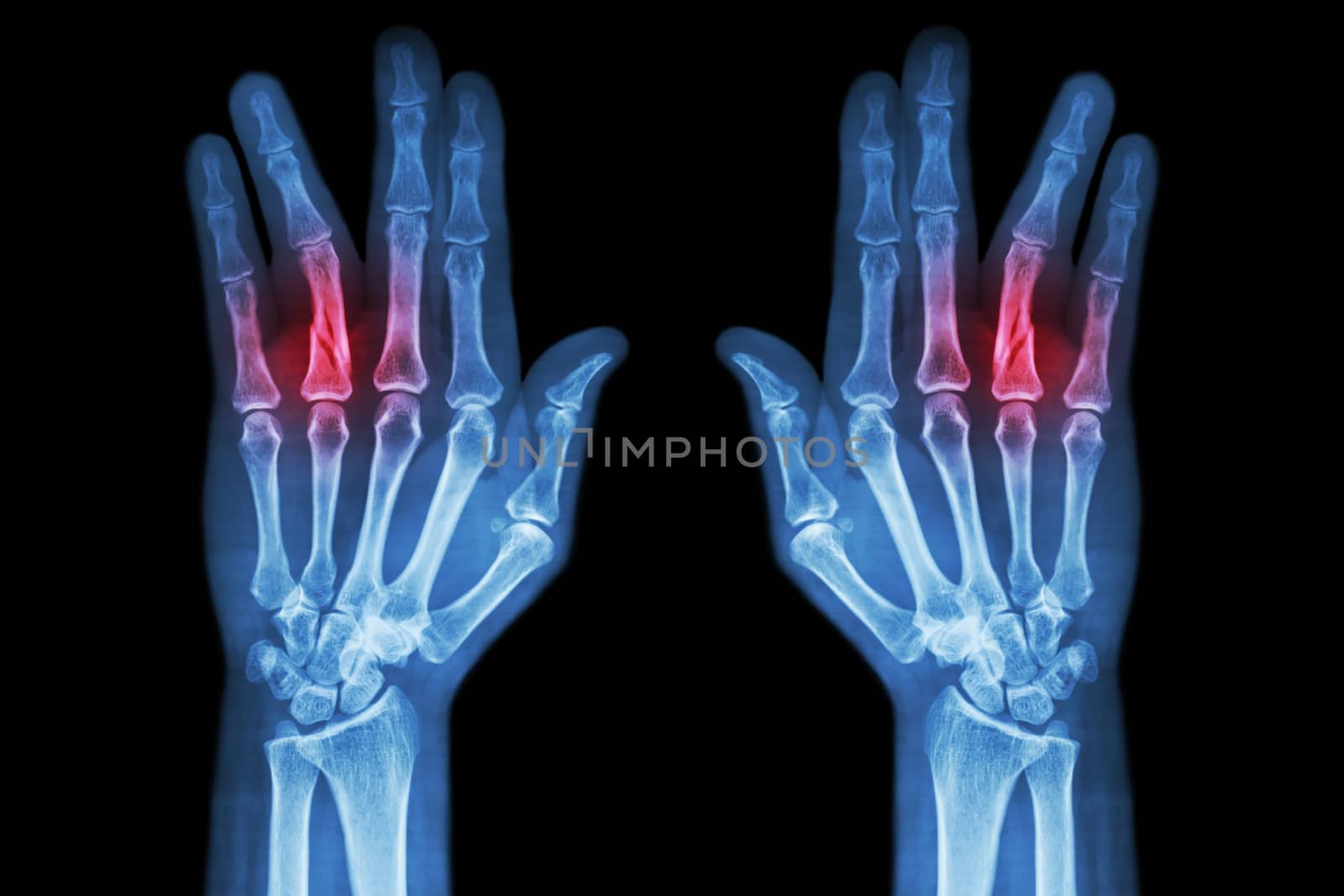 Fracture shaft of proximal phalange of ring finger ( film x-ray both hand AP )