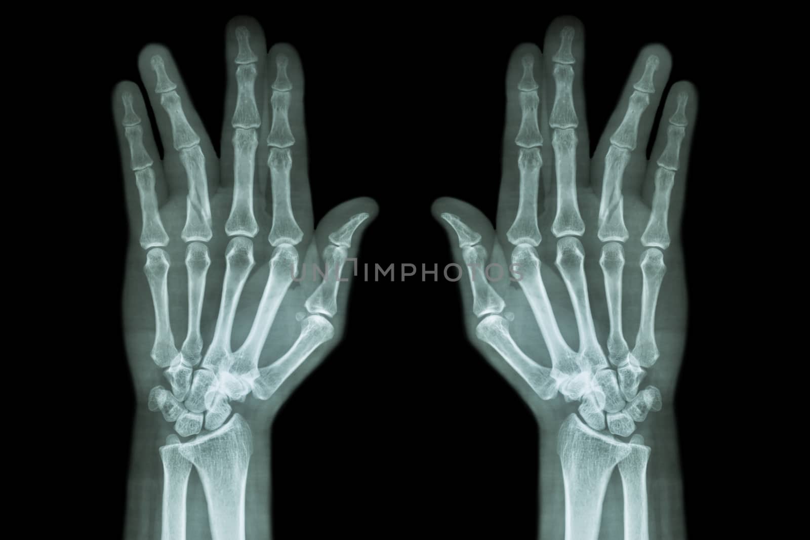 Fracture shaft of proximal phalange of ring finger ( film x-ray both hand AP )