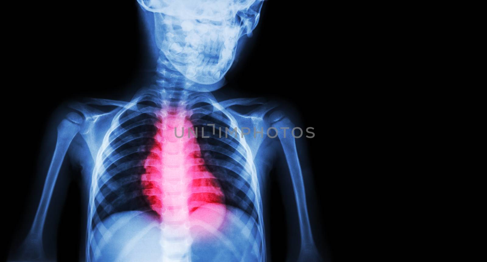 Ischemic Heart Disease , Myocardial Infarction ( MI ) ( Film x-ray body of human with heart disease and blank area at right side ) ( Cardiopulmonary resuscitate and Cardiovascular concept )