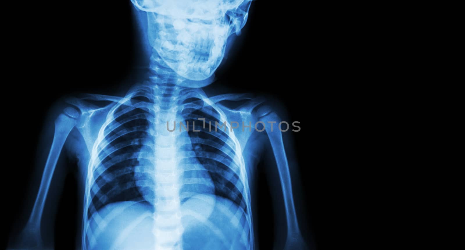 Film x-ray body of child and blank area at right side ( Medical background )