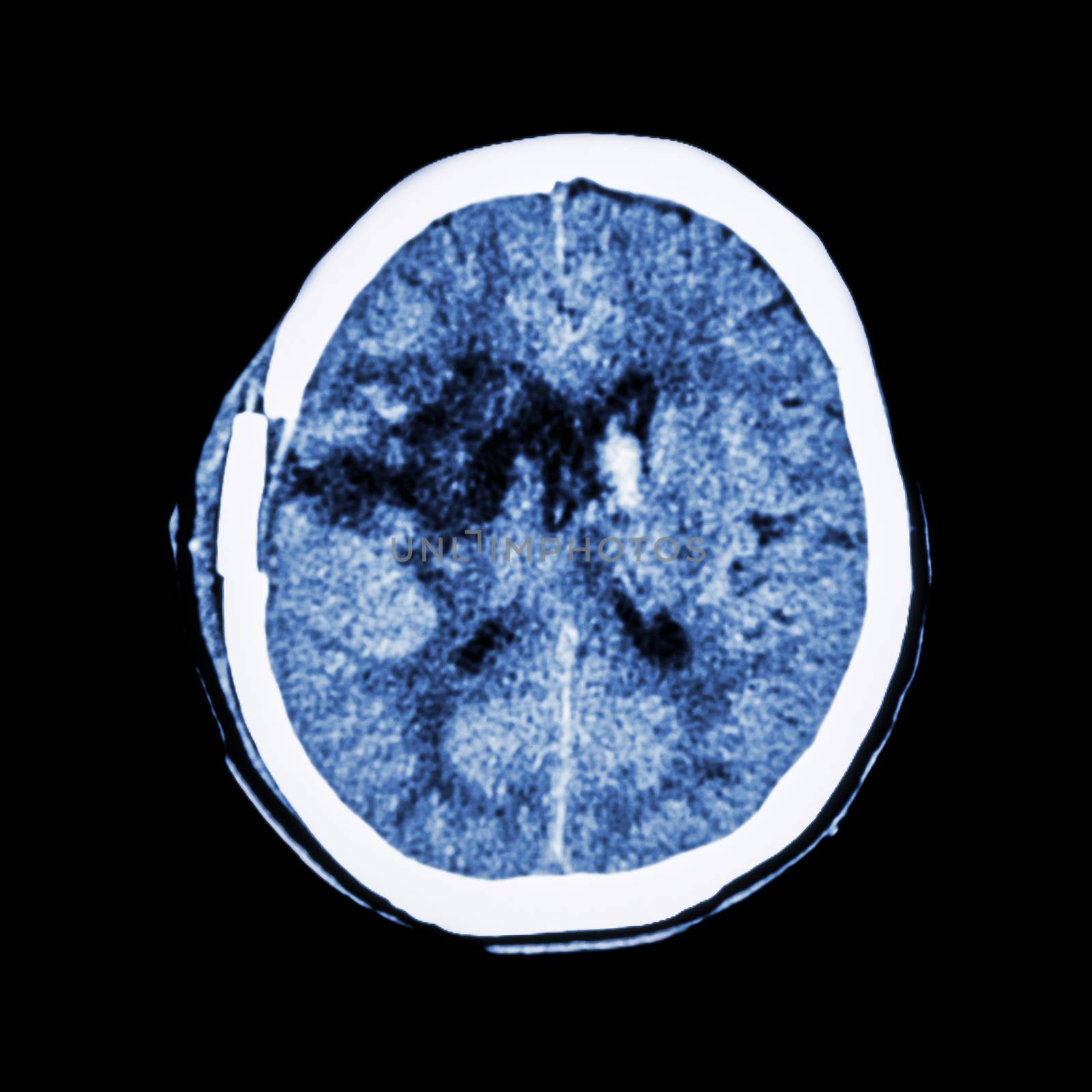 CT scan of brain : show old right basal ganglia hemorrhage with brain edema ( status post craniotomy ) ( Hemorrhagic stroke ) by stockdevil
