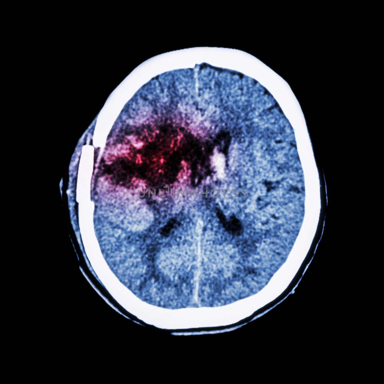 CT scan of brain : show old right basal ganglia hemorrhage with brain edema ( status post craniotomy ) ( Hemorrhagic stroke )