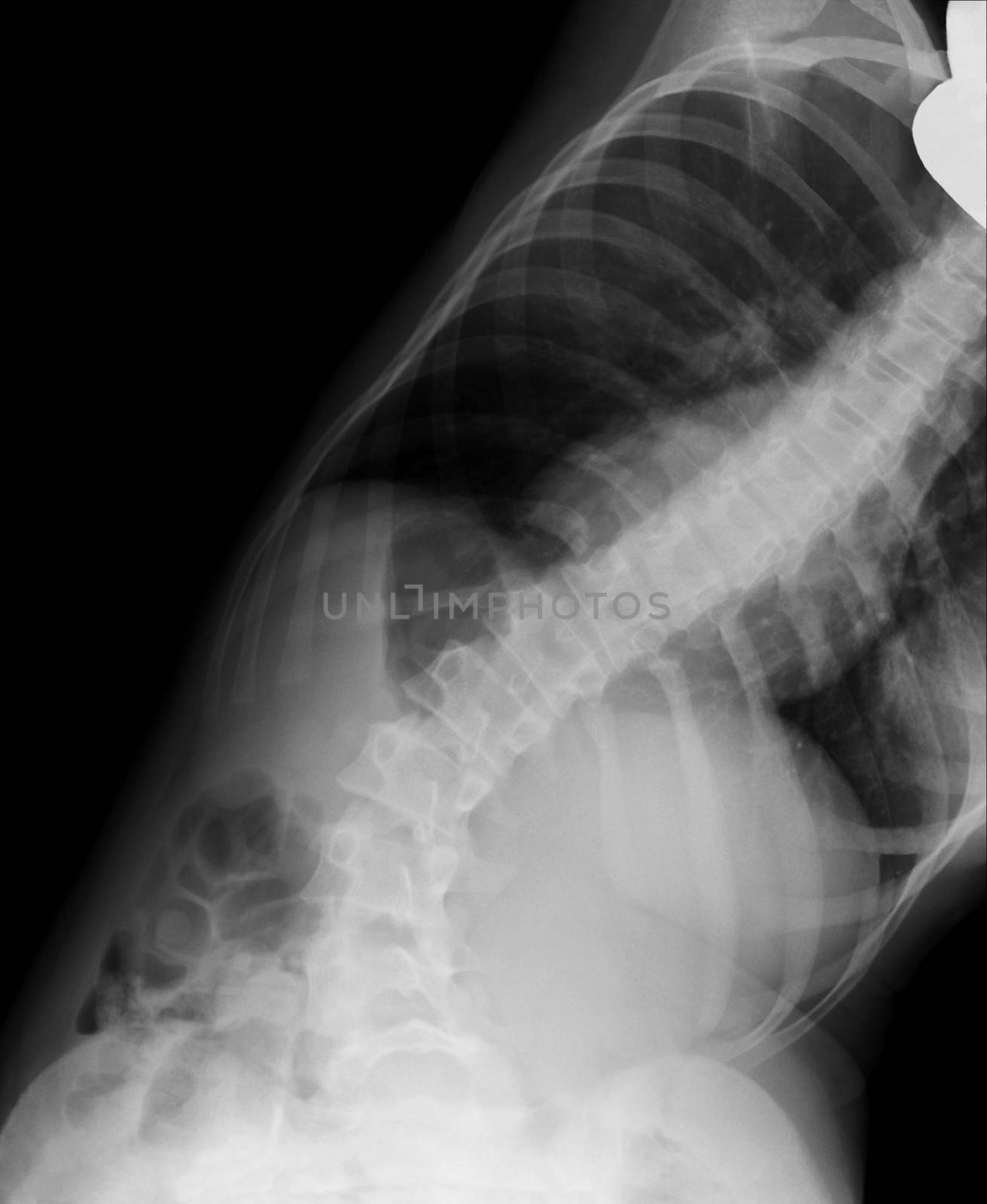 Scoliosis film x-ray show spinal bend in teenager patient by Draw05