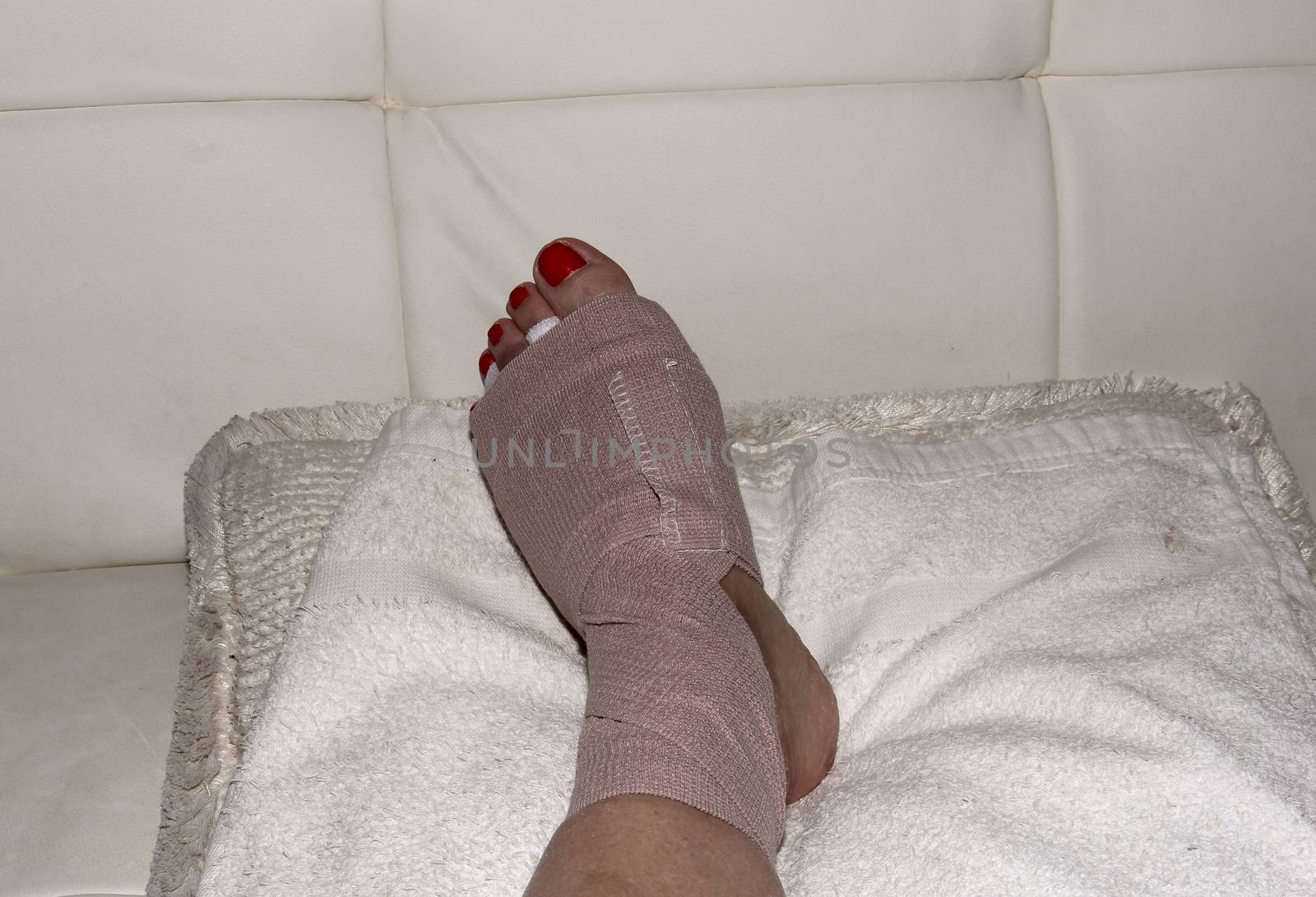 Foot after Morton’s neuroma surgery between the second and third toe.  After surgery, the bruised foot is wrapped and then placed in a protective boot.