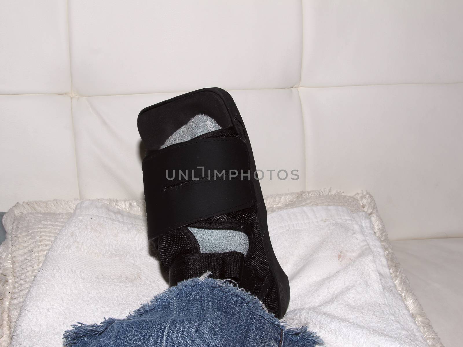 Foot after Morton’s neuroma surgery between the second and third toe.  After surgery, the bruised foot is wrapped and then placed in a protective boot.