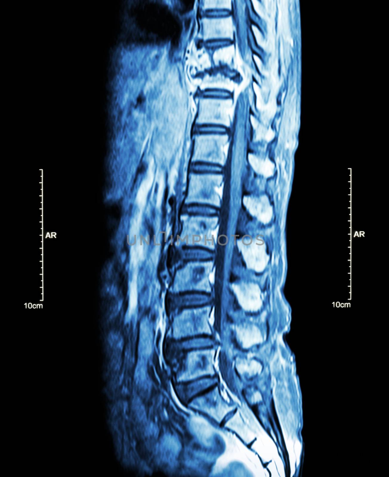 Spine metastasis ( cancer spread to thoracic spine ) ( MRI of thoracic and lumbar spine : show thoracic spine metastasis and compress spinal cord ( Myelopathy ) ) ( sagittal plane )