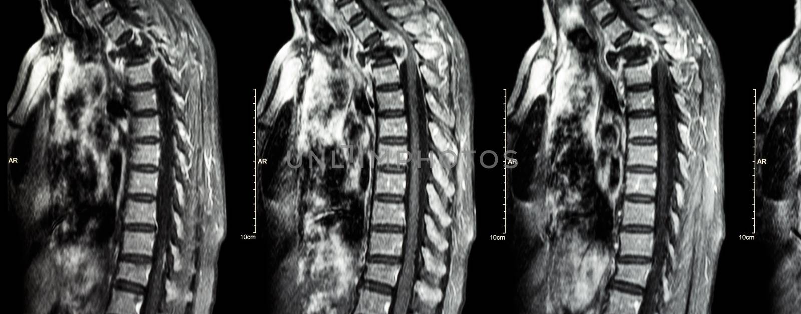 Spine metastasis ( cancer spread to thoracic spine ) ( MRI of cervical and thoracic spine : show thoracic spine metastasis and compress spinal cord ( Myelopathy ) ) ( sagittal plane )