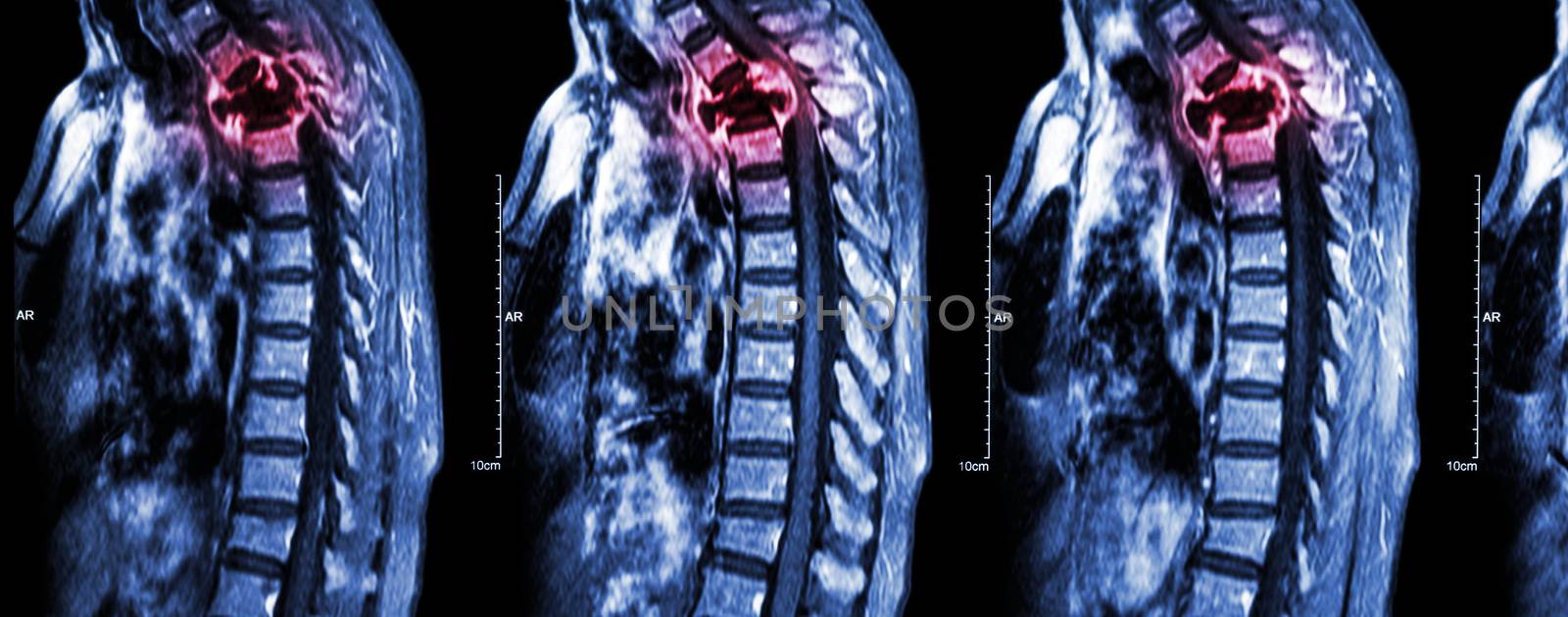 Spine metastasis ( cancer spread to thoracic spine ) ( MRI of cervical and thoracic spine : show thoracic spine metastasis and compress spinal cord ( Myelopathy ) ) ( sagittal plane )