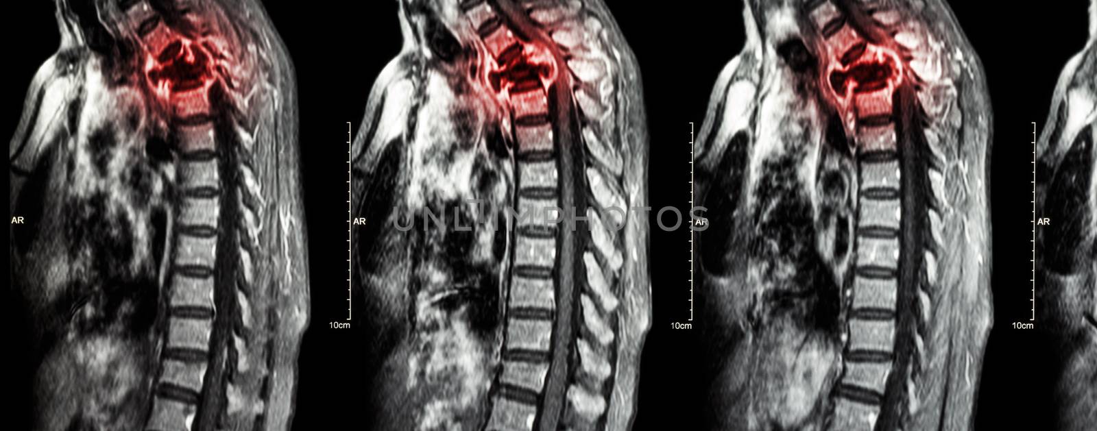 Spine metastasis ( cancer spread to thoracic spine ) ( MRI of cervical and thoracic spine : show thoracic spine metastasis and compress spinal cord ( Myelopathy ) ) ( sagittal plane )