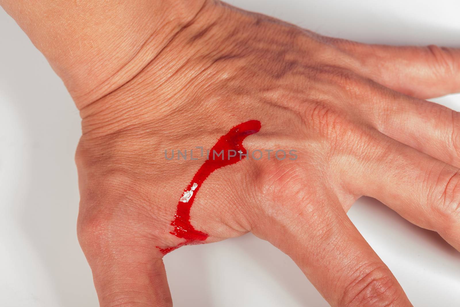 Subcutaneous medical injection concept with a small hypodermic syringe filled with a red liquid penetrating the skin and producing a flow of dripping blood in a close up view