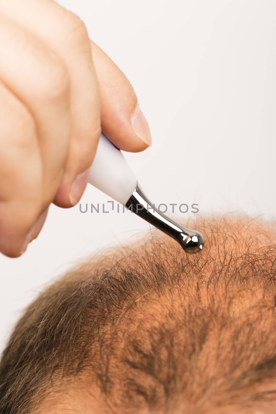 40s man with an incipient baldness , treatment, close-up, white background