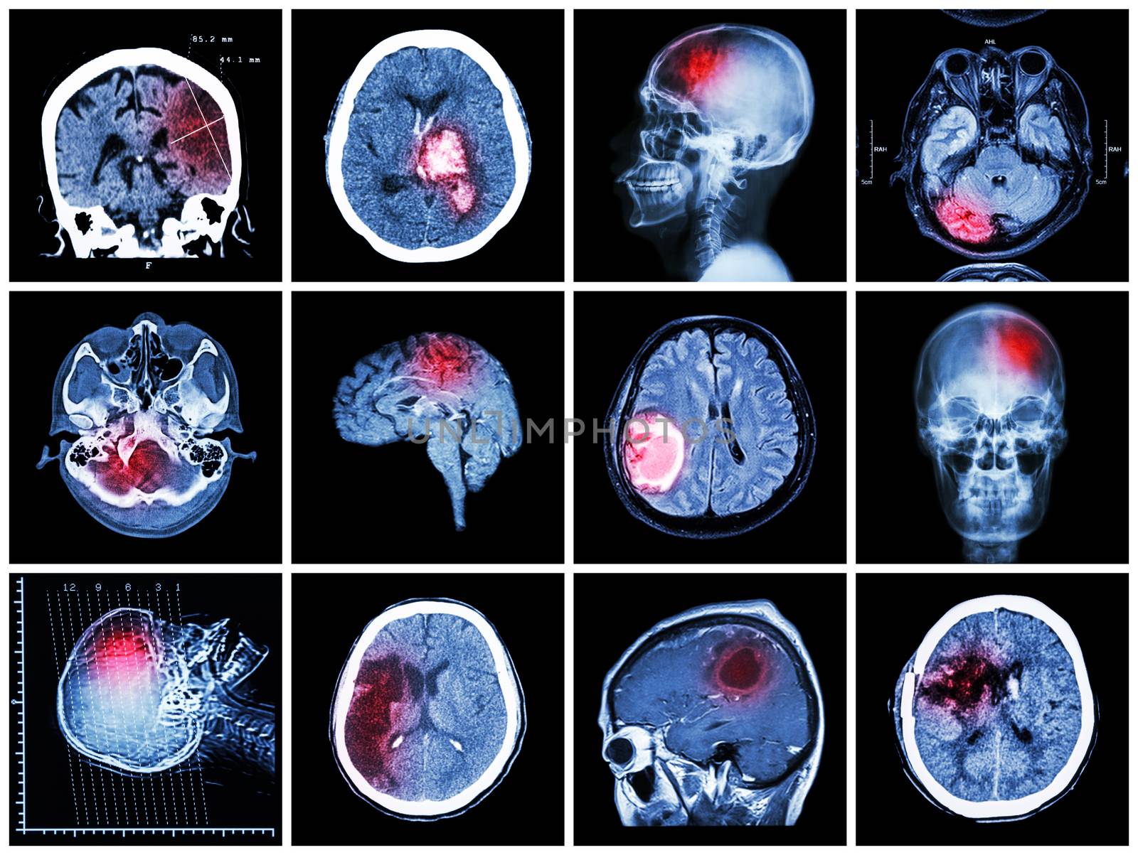 Collection of brain disease ( CT scan and MRI of brain : show cerebral infarct , intracerebral hemorrhage , brain tumor , basal ganglia hemorrhage ( status post craniotomy ) ) ( health care concept )