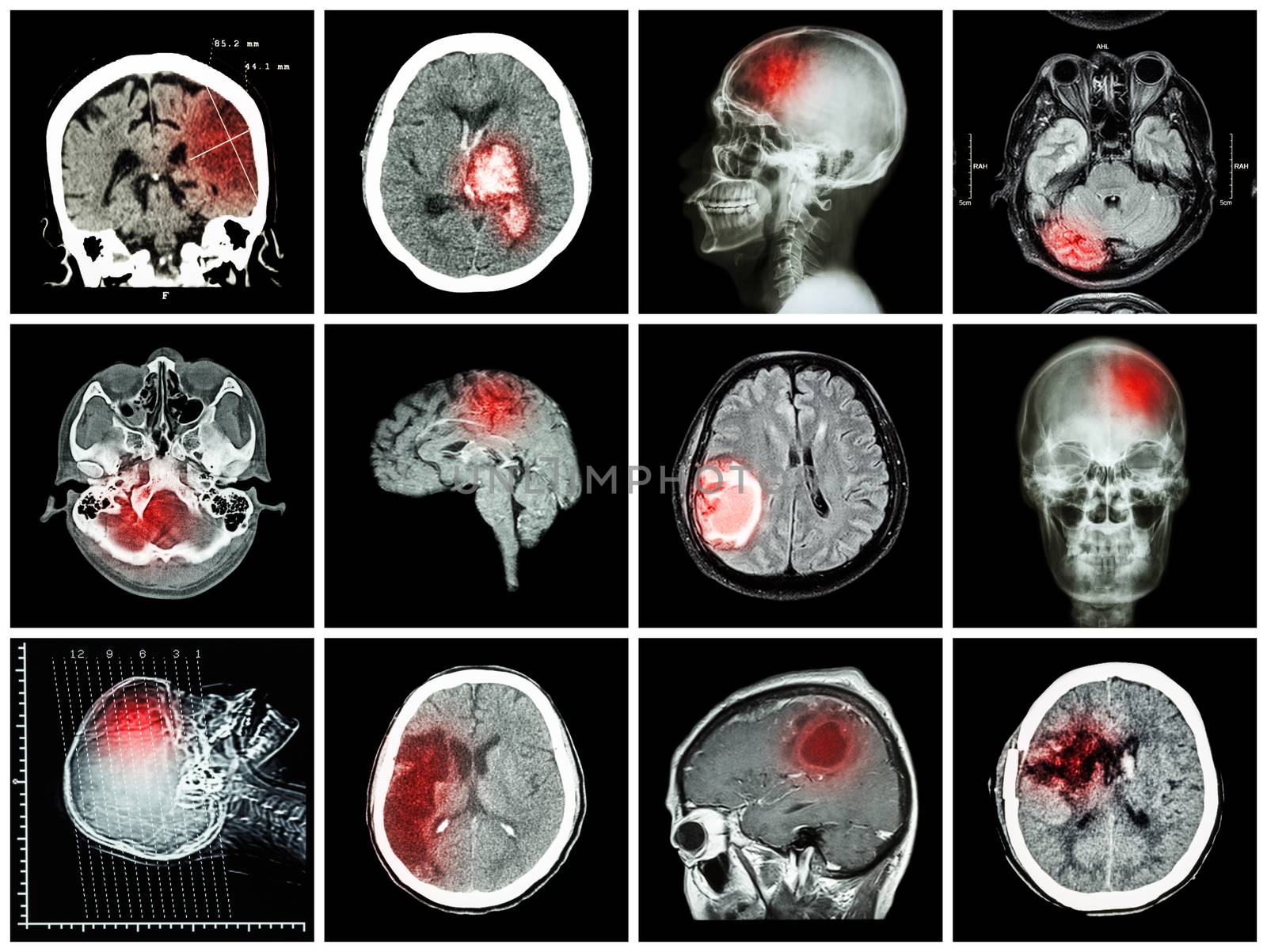 Collection of brain disease ( CT scan and MRI of brain : show cerebral infarct , intracerebral hemorrhage , brain tumor , basal ganglia hemorrhage ( status post craniotomy ) ) ( health care concept )