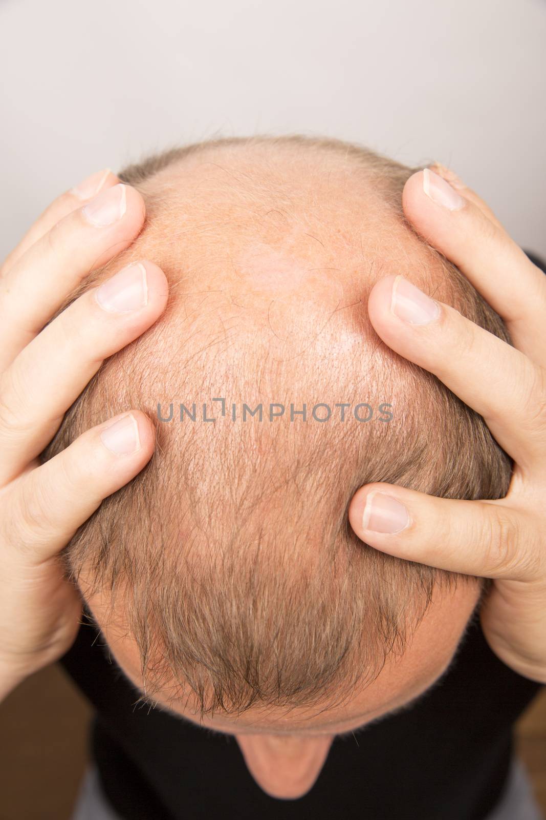 man controls hair loss by CatherineL-Prod
