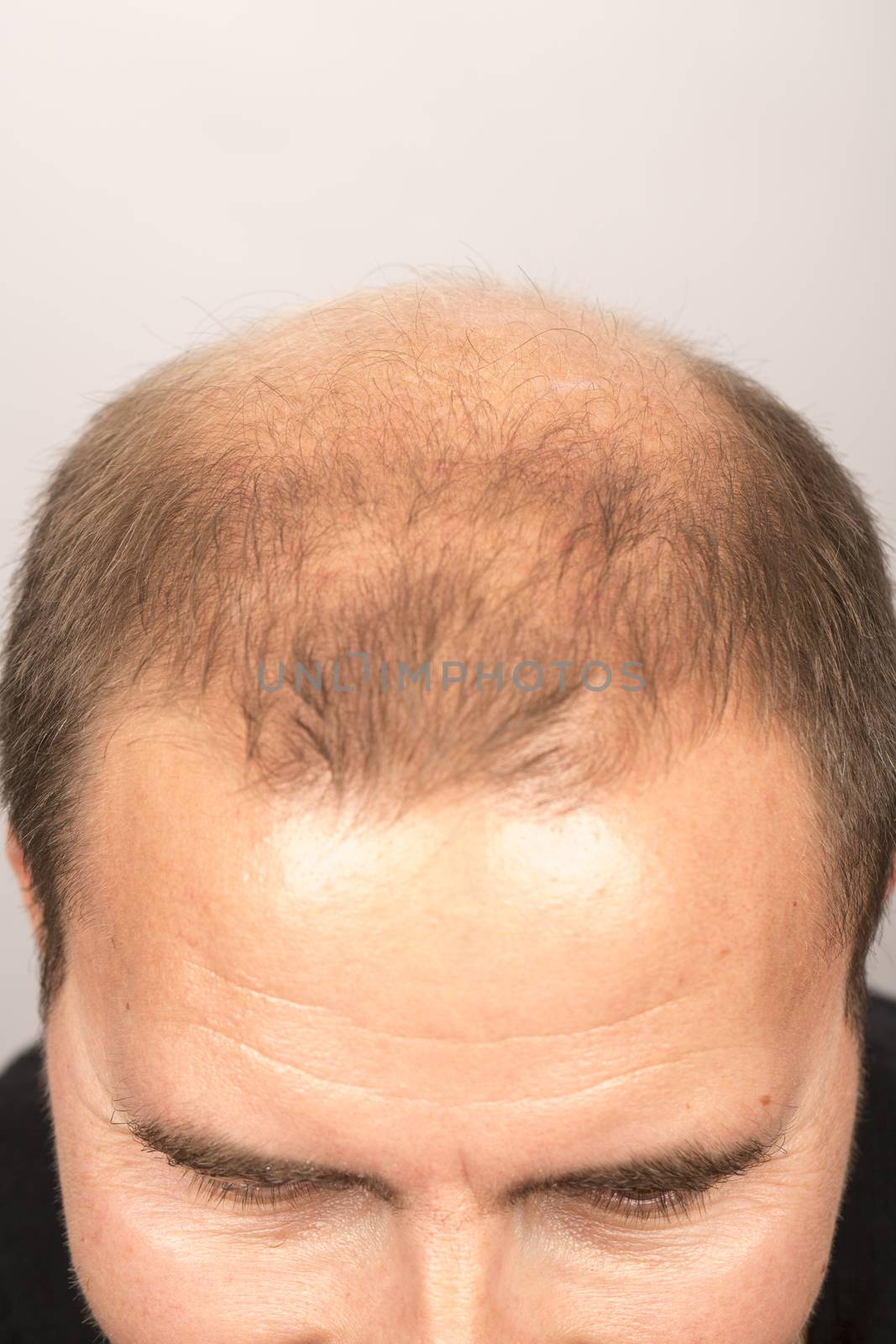 man controls hair loss by CatherineL-Prod