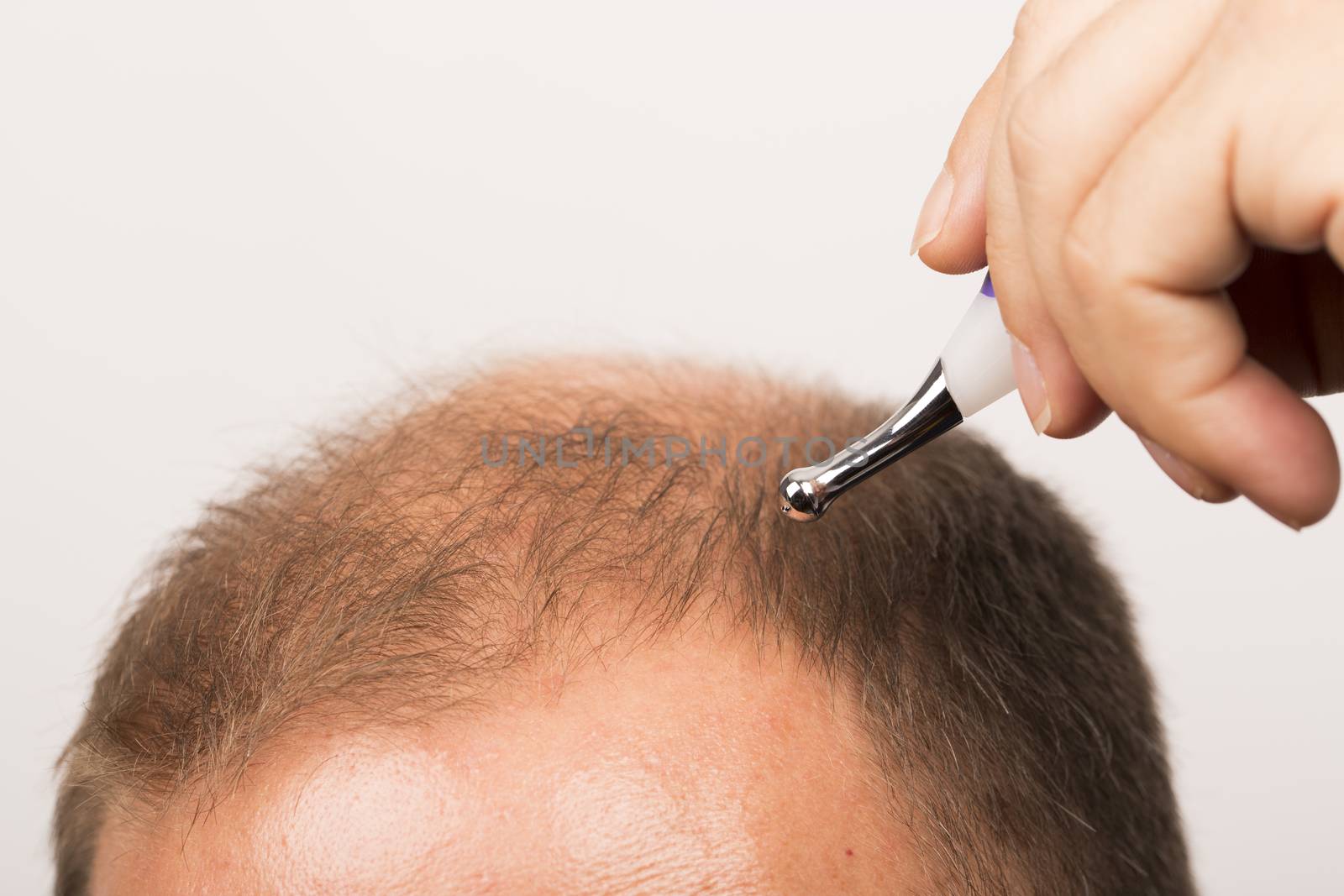 man controls hair loss stress alopecia cancer treatment