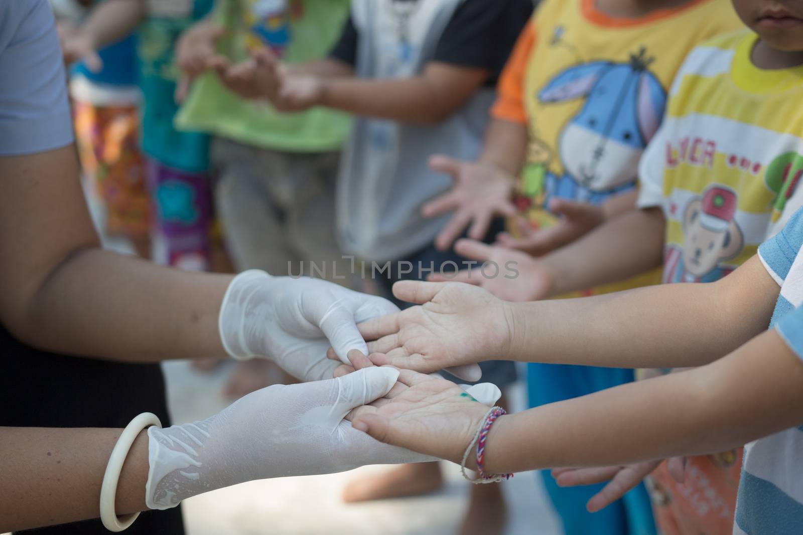 Hand foot mouth disease in child