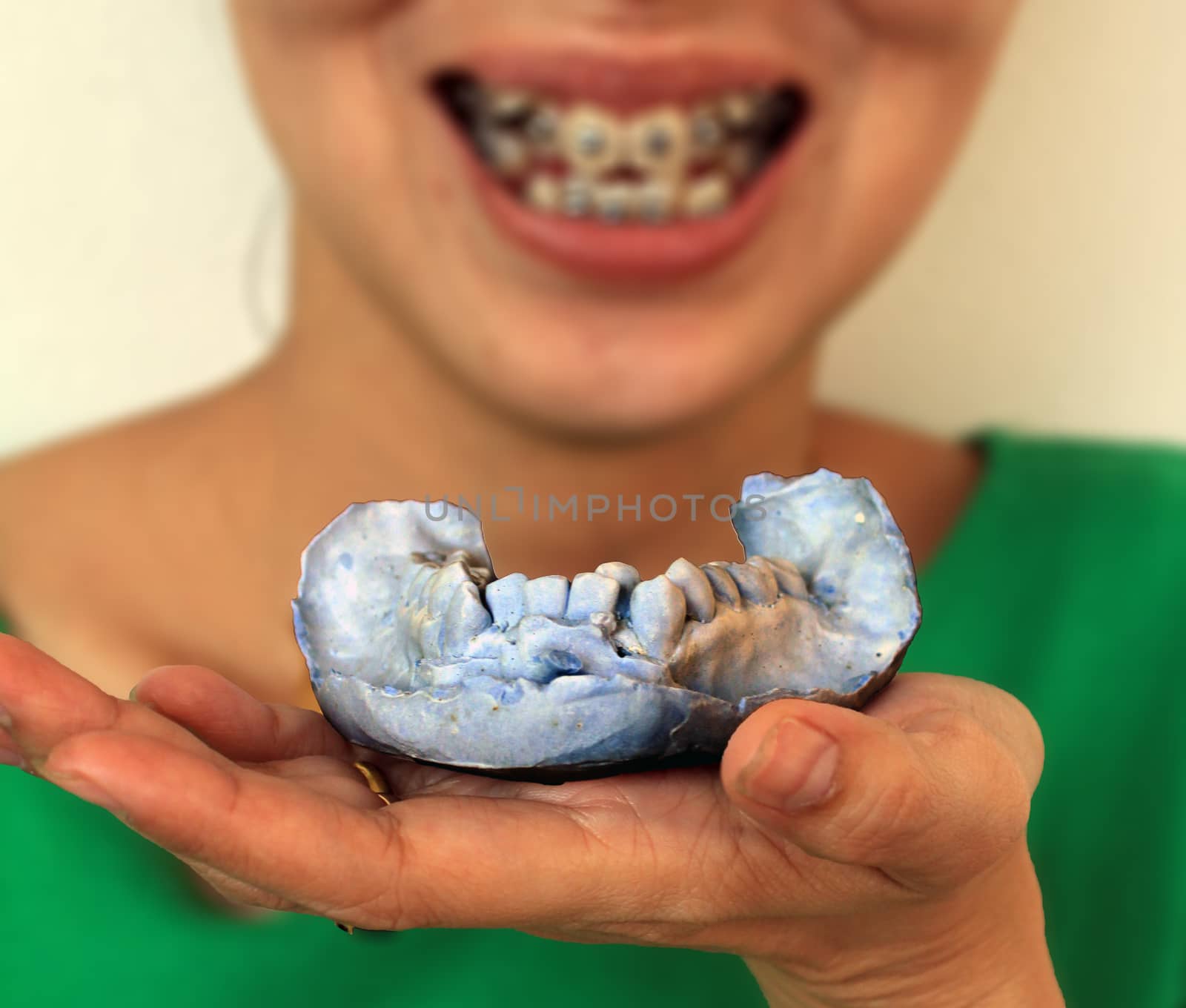 dental arch plaster mold and brace
