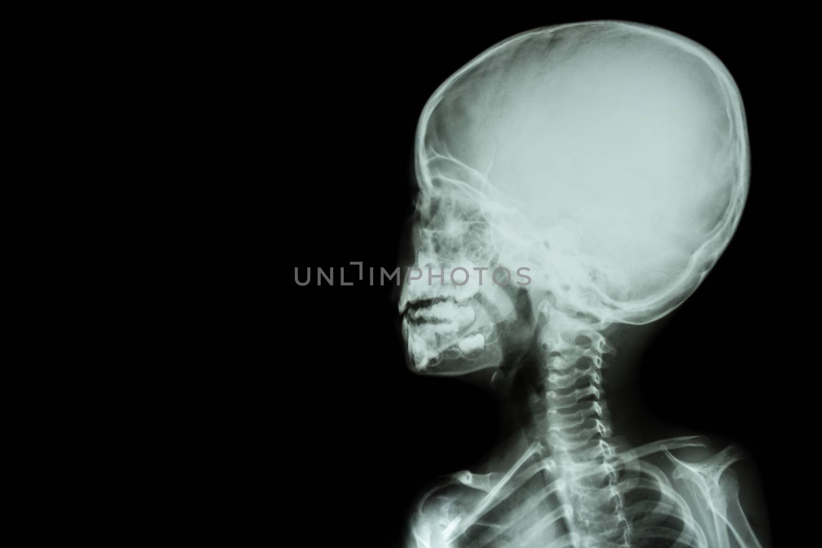 film x-ray skull and body of child ( blank area at left side )