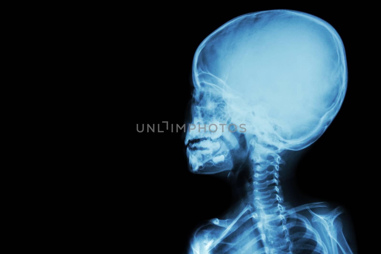 film x-ray skull and body of child ( blank area at left side )