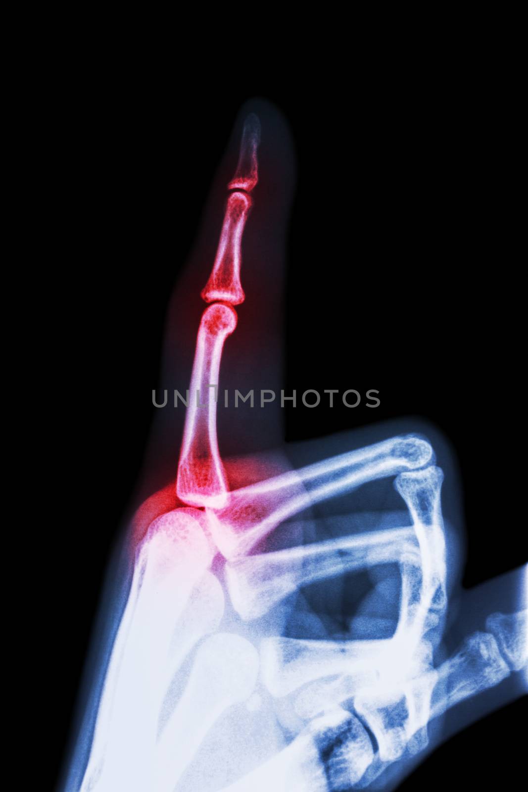 Rheumatoid arthritis , Gouty arthritis ( film x-ray index finger and hand ( point a finger ) and inflame at finger )