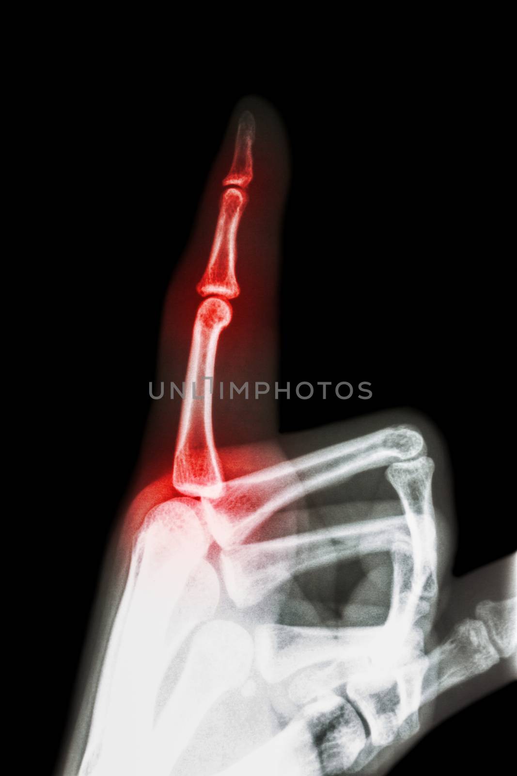 Rheumatoid arthritis , Gouty arthritis ( film x-ray index finger and hand ( point a finger ) and inflame at finger )