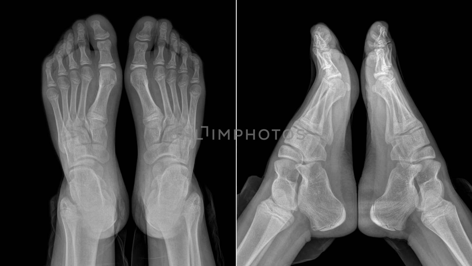 X-ray image of the girl's feet (two views with partially outline by dsmsoft