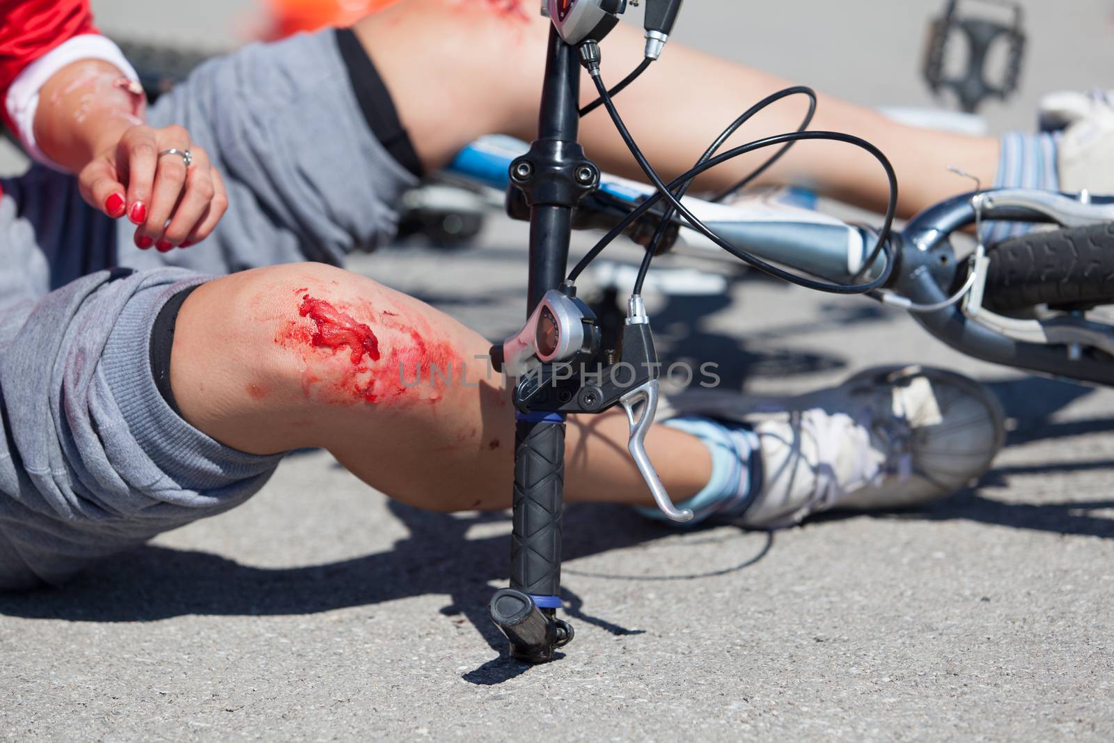 Bike fall injuries by wellphoto