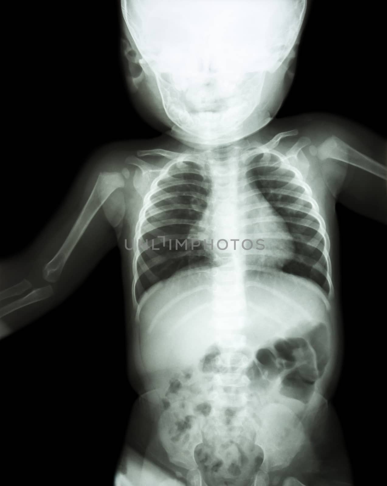 Film x-ray child 's body ( normal baby )