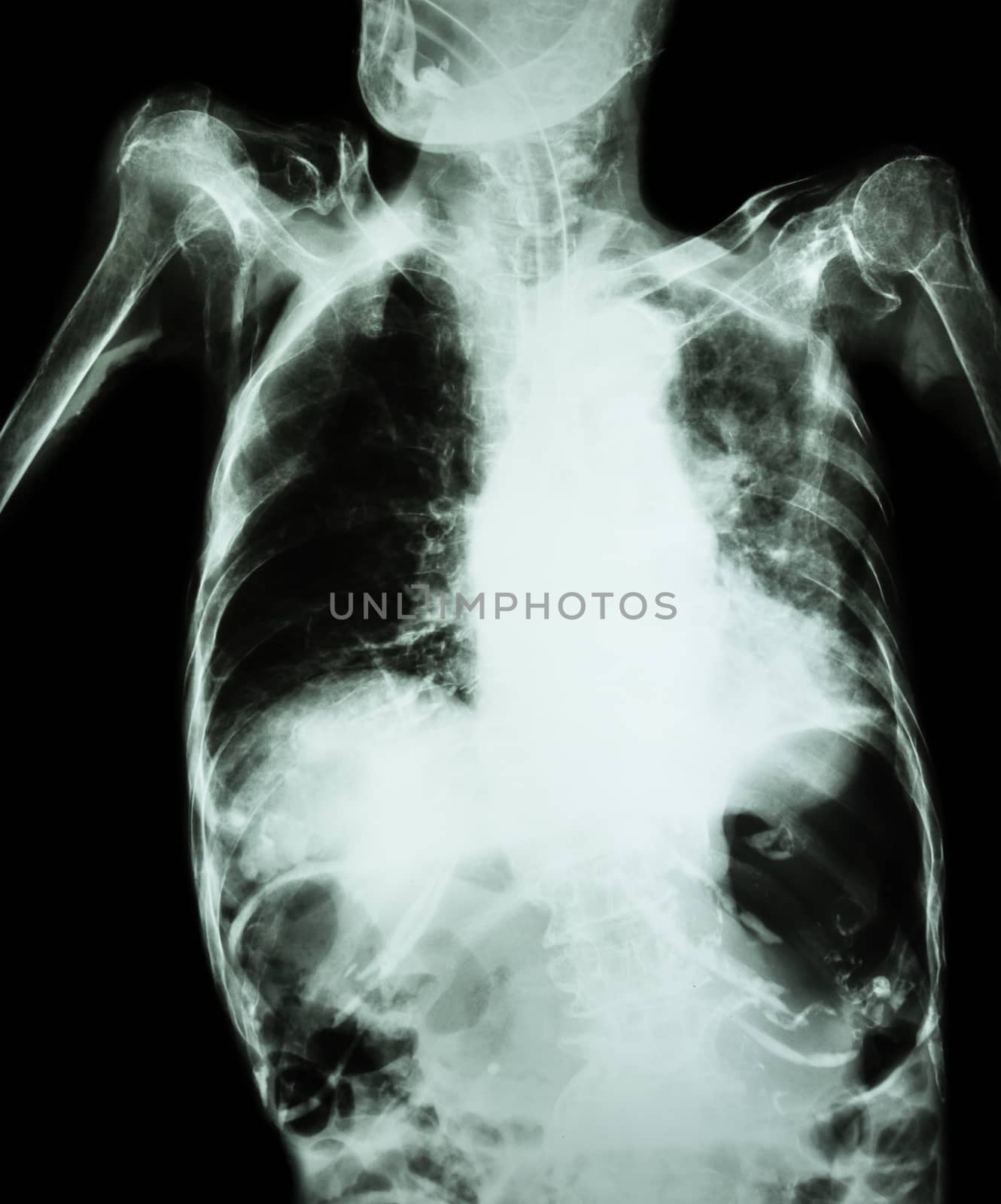 Pulmonary Tuberculosis with acute respiratory failure ( Film chest x-ray of old patient show alveolar and interstitial infiltration both lung with endotracheal tube ) due to mycobacterium tuberculosis