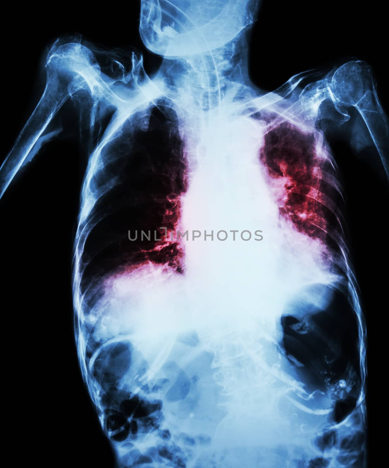 Pulmonary Tuberculosis with acute respiratory failure ( Film chest x-ray of old patient show alveolar and interstitial infiltration both lung with endotracheal tube ) due to mycobacterium tuberculosis