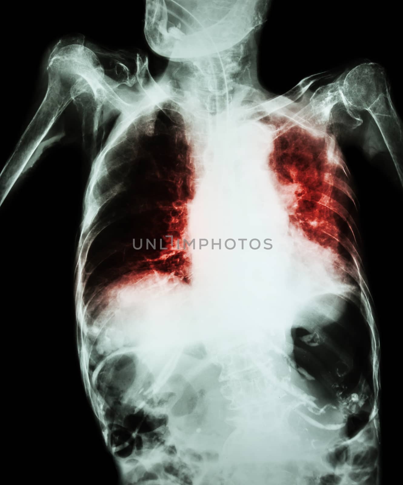 Pulmonary Tuberculosis with acute respiratory failure ( Film chest x-ray of old patient show alveolar and interstitial infiltration both lung with endotracheal tube ) due to mycobacterium tuberculosis