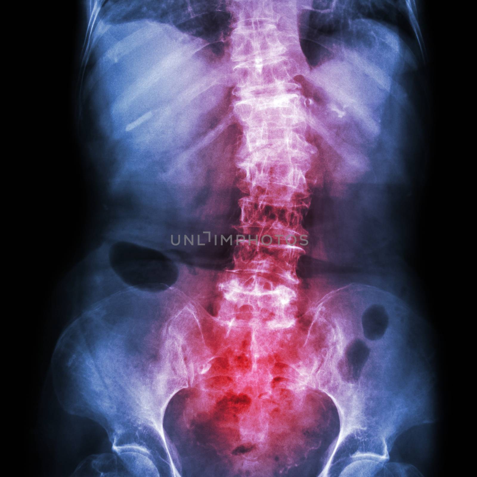 Spondylosis and Scoliosis ( film x-ray lumbar - sacrum spine show crooked spine ) ( old patient ) ( Spine Healthcare ) by stockdevil