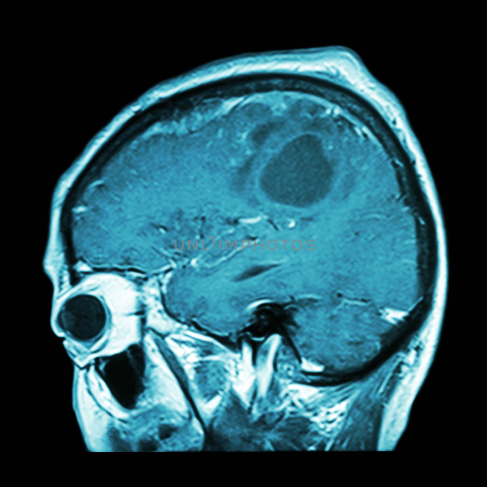 Film MRI of brain with brain tumor ( Sagittal plane , side view , lateral view ) ( Medical , Health care , Science Background ) by stockdevil