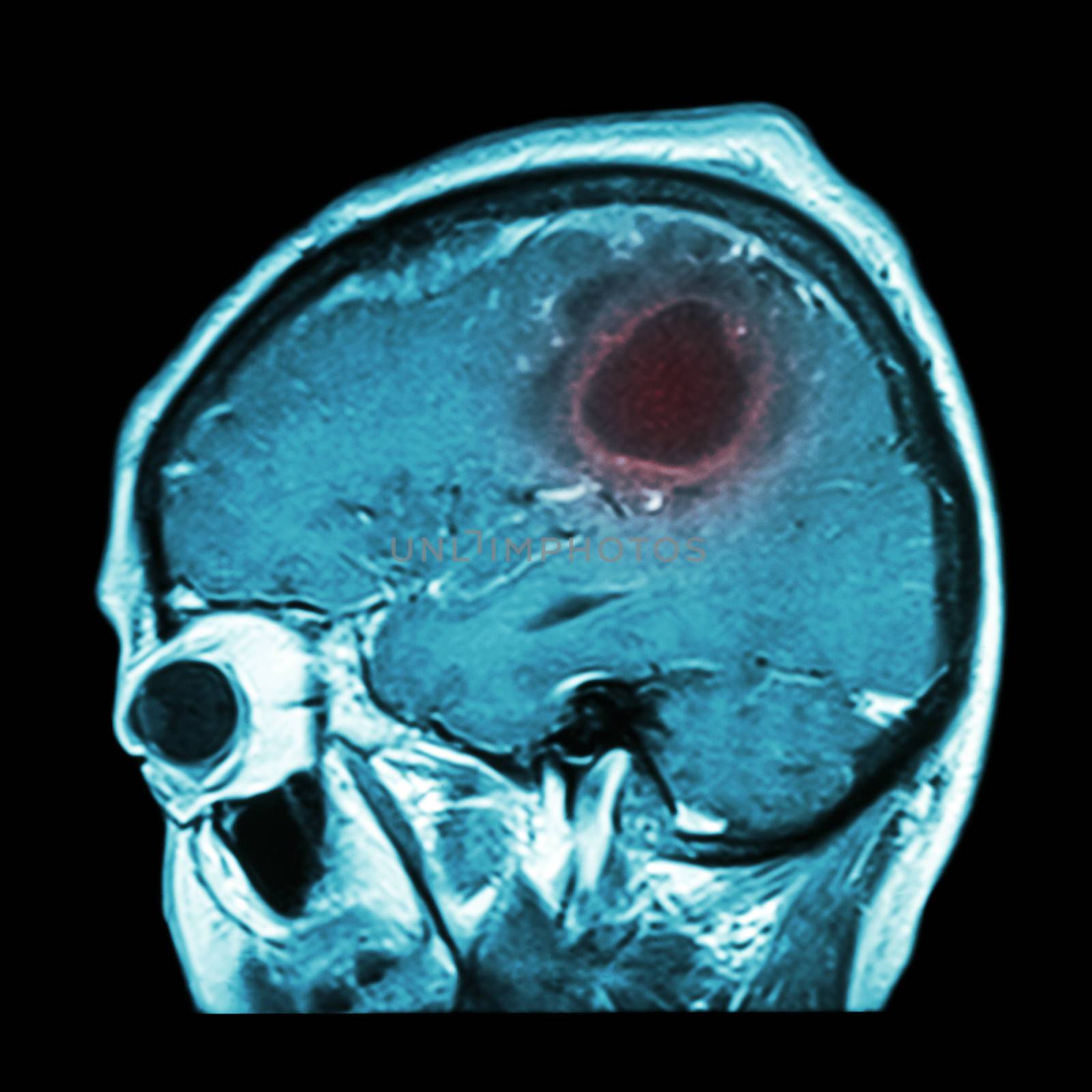 Film MRI of brain with brain tumor ( Sagittal plane , side view , lateral view ) ( Medical , Health care , Science Background )