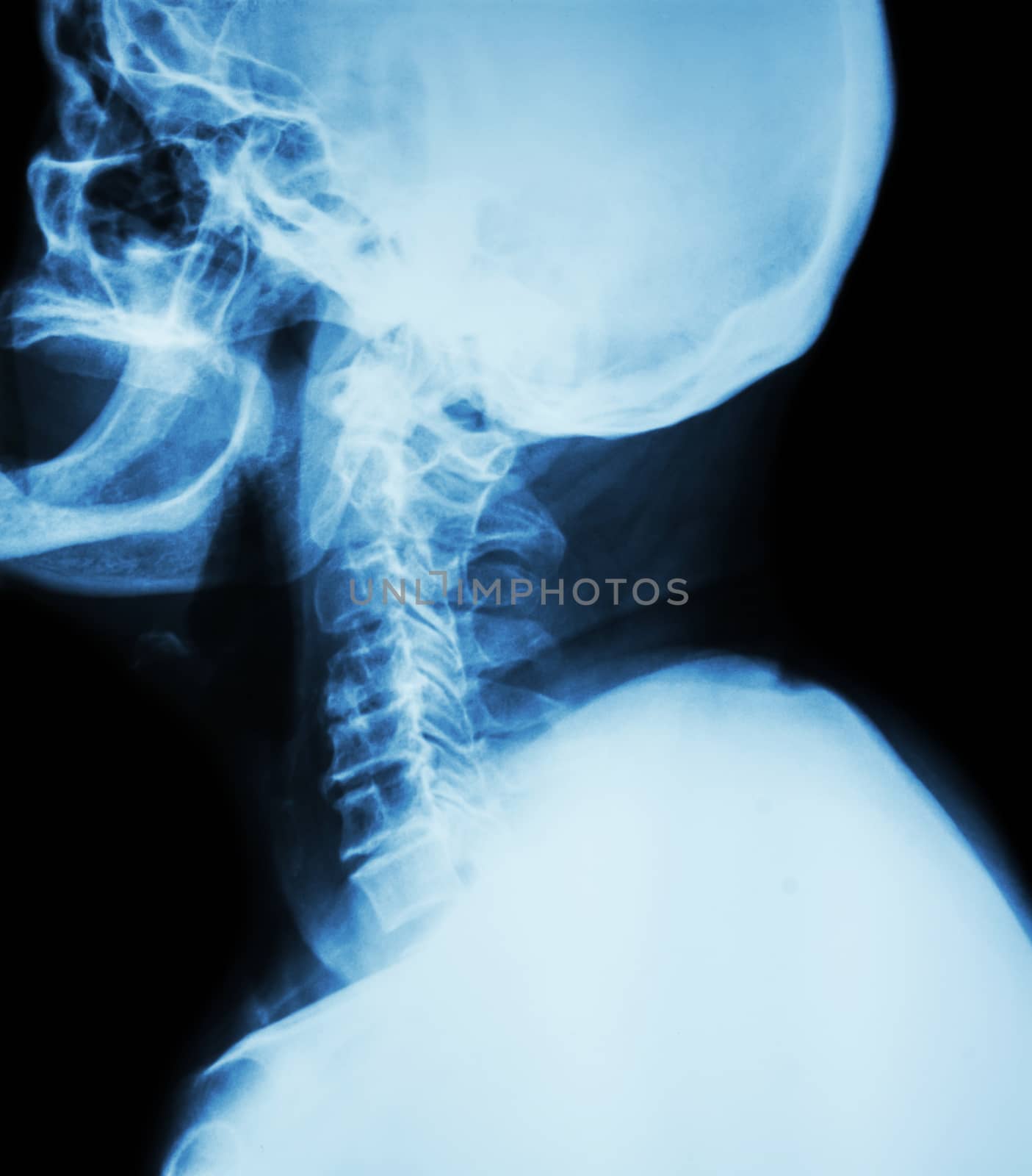 Cervical spondylosis . Film x-ray of cervical spine ( lateral position ) ( side view )