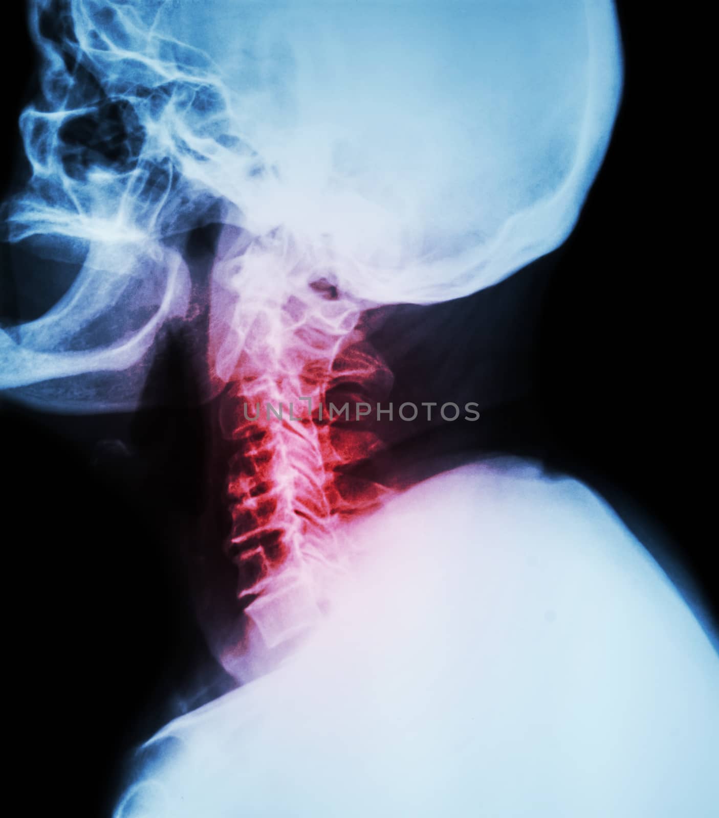 Cervical spondylosis . Film x-ray of cervical spine ( lateral position ) ( side view )