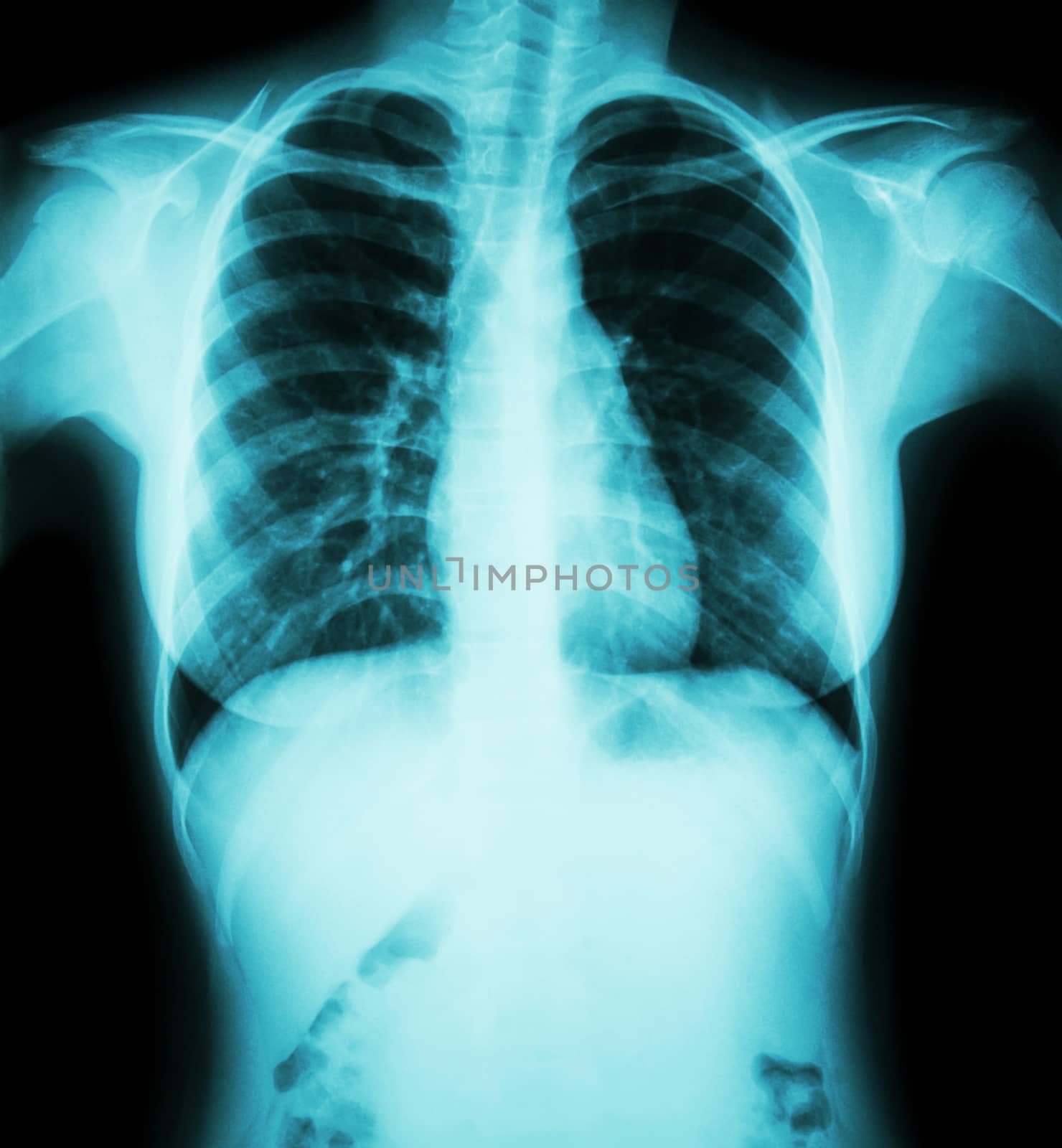 Film chest x-ray : show normal chest of woman