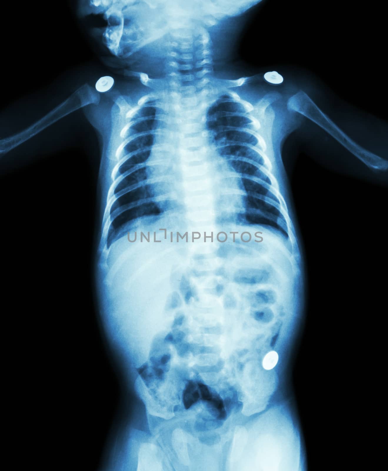 Film X-ray whole body of infant