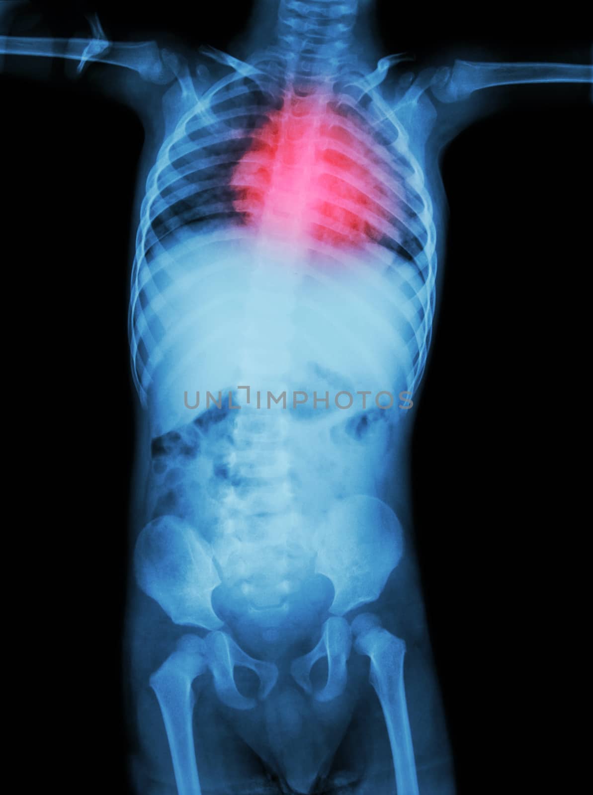 Rheumatic heart disease , Valvular heart disease ( Film x-ray body of child with red area at heart ) ( Medical , Science and Healthcare concept )