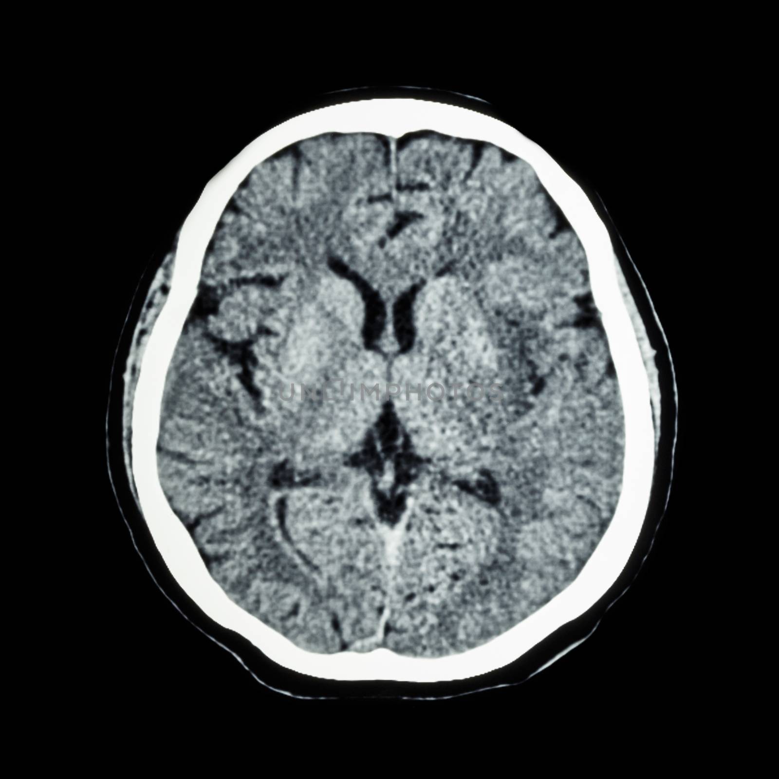 CT scan of brain : show normal human 's brain ( CAT scan ) by stockdevil