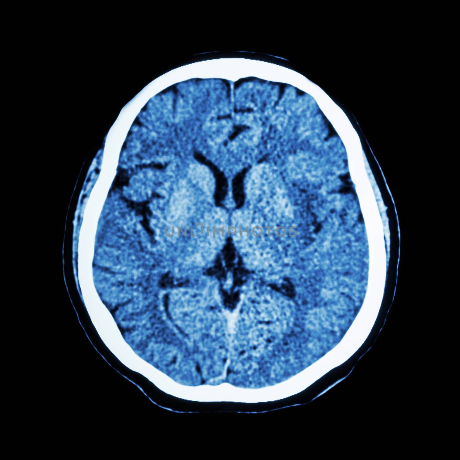 CT scan of brain : show normal human 's brain ( CAT scan )